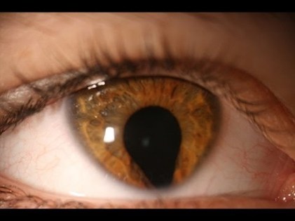 coloboma
